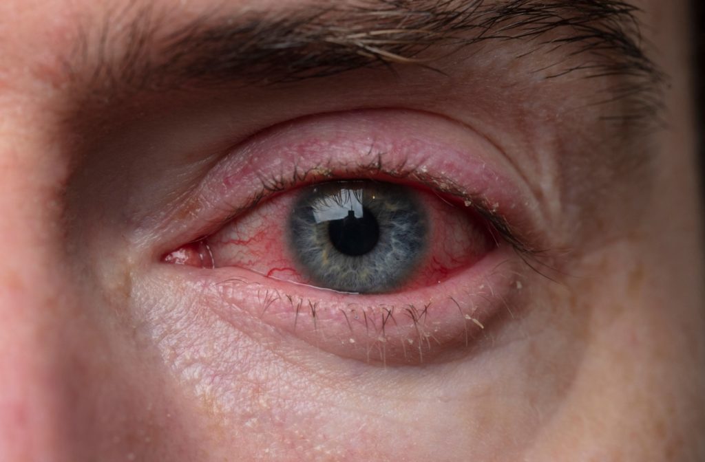 A close-up of a person's red and irritated eye, indicating blepharits