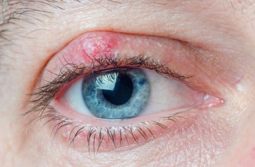 A close-up of a person's eye, affected with a chalazion on the upper lid.