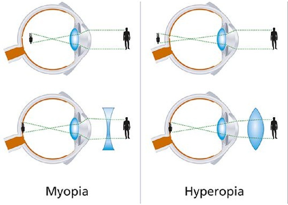 A diagram of myopia vs. hyperopia